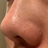 Nose Acne